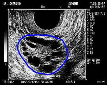 normal vs polycystic ovaries ultrasound